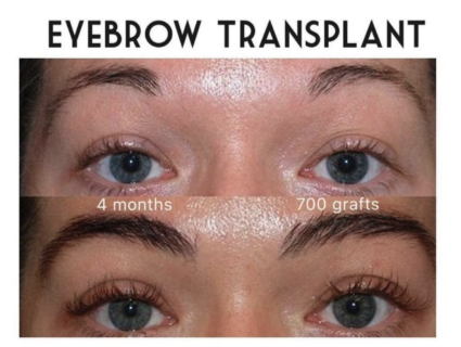 eyebrow transplant